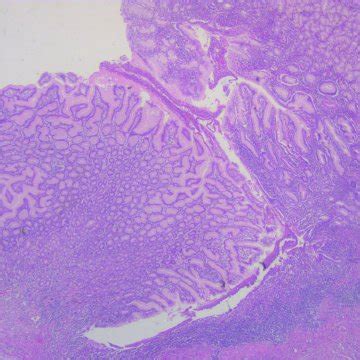 Histology from a section of the gastric antrum revealed marked foveolar ...