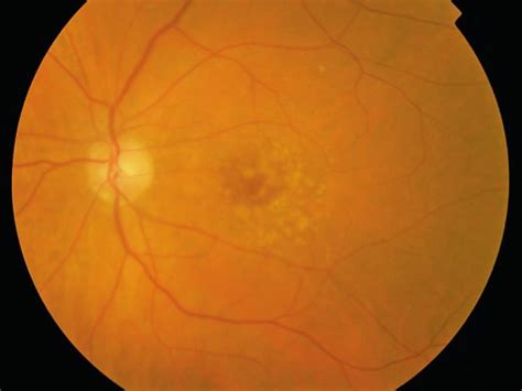 Eylea vs Lucentis for Treatment-Naive Neovascular AMD