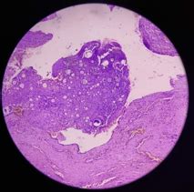 Histopathology showing the typical sporangia containing numerous spores ...