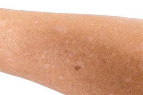 White Spots on Skin from Sun Exposure: How To Prevent & Treat