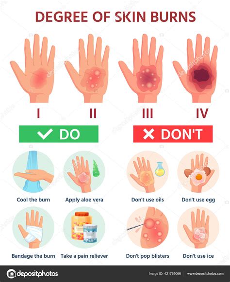 Burns degree. First aid for burn wound. Fire damage to skin classification. Hand blisters ...