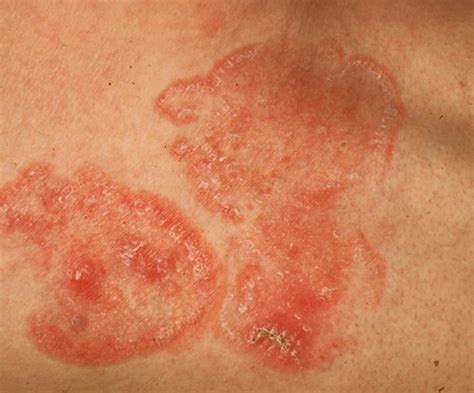 Mycosis Fungoides - Pictures, Staging, Symptoms, Treatment and Causes | HubPages