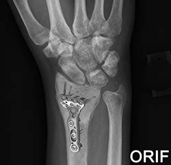 ORIF Distal Radius Fracture Chandler, AZ | Casa Grande | Hip Fracture ...