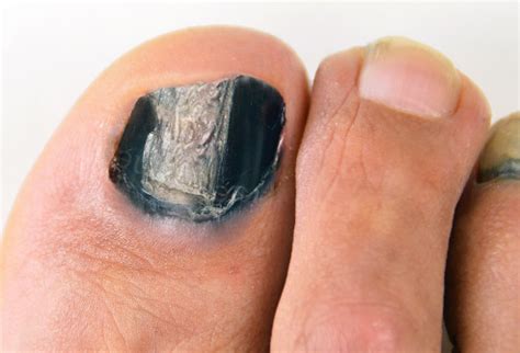 How To Get Rid Of Black Toenail Fungus | Nail Care Hub