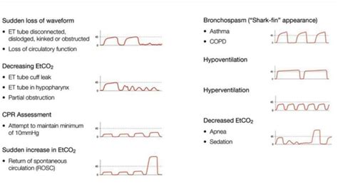 end tidal co2 waveforms - Rolande Kaplan