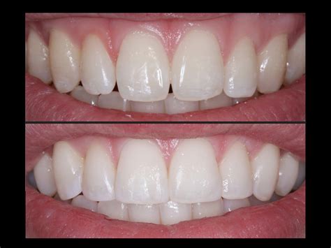 Dental Tips - Smile Dentistry: All You Need To Know About Tooth Bonding