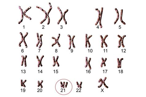 Cách phát hiện hội chứng Down khi mang thai mẹ bầu cần biết ⋆ Hồng Ngọc ...