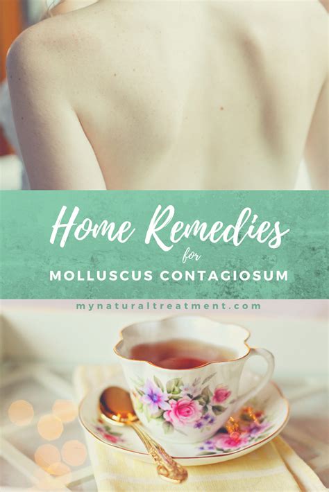 10 Amazing Home Remedies for Molluscum Contagiosum