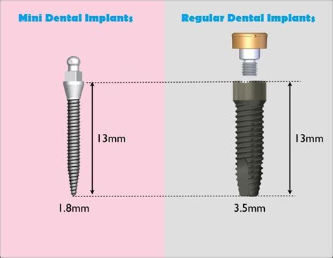 Mini Dental Implants vs. Regular Dental Implants | Mini dental implants, Dental implants, Teeth ...