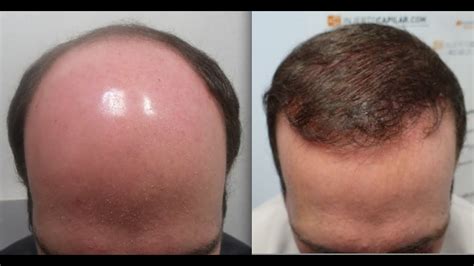 Seborrheic Dermatitis Hair Loss | Galhairs