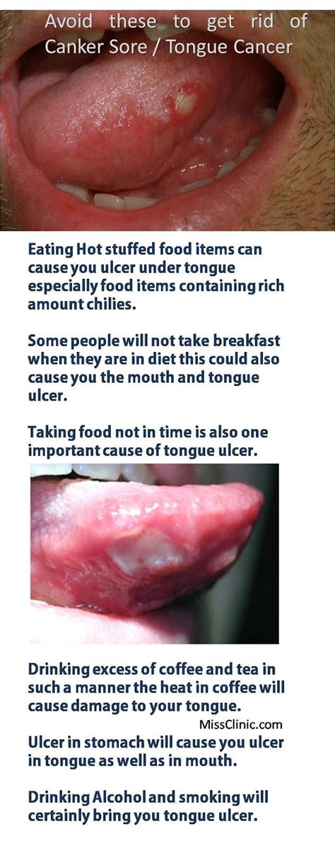 Avoid Periodical Tongue Ulcer Remedies ~ Missclinic | Tongue ulcer remedies, Health heal, Remedies