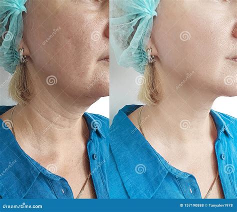 Woman Neck Wrinkles Facelift before after Correction Treatment Removal Stock Photo - Image of ...