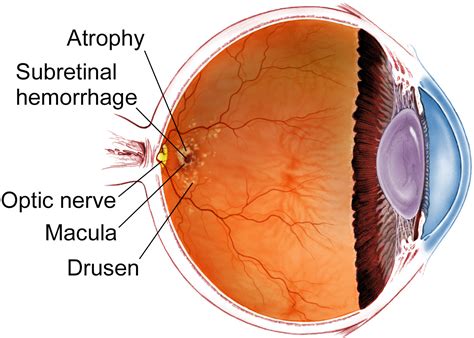 Age-related Macular Degeneration - The American Society of Retina Specialists - Patients - The ...