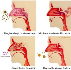 Postnasal Drip in Children - Pediatric Pulmonologists