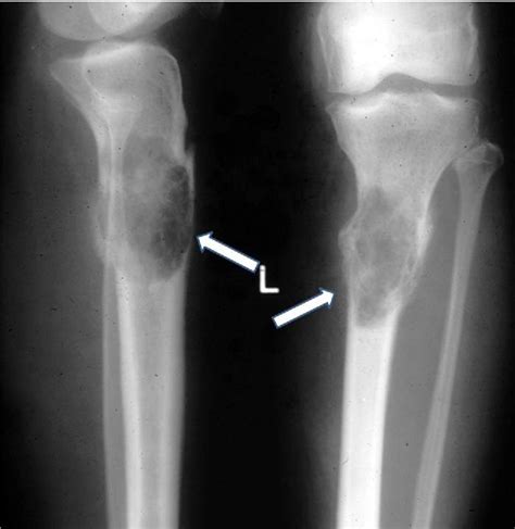 Osteitis Fibrosa Cystica X Ray