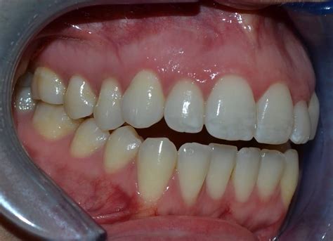 Maxillary and Mandibular Osteotomy Before & After