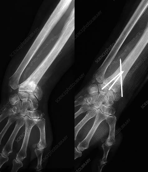 Colles' wrist fracture, X-ray - Stock Image - M330/1648 - Science Photo ...