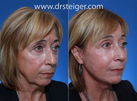 Blepharoplasty Eyelid Surgery Photos Before and After