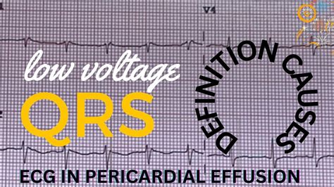 Low Voltage ECG (EKG): Criteria & Causes | ECG (EKG) in Pericardial Effusion - YouTube