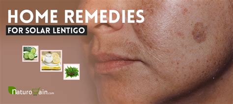 9 Best Home Remedies for Solar Lentigo to Improve Skin Health