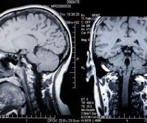 What Is Lobotomy Effect - Ideas of Europedias