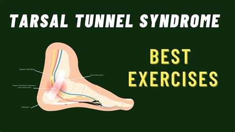 Tarsal Tunnel Syndrome: 6 Best Exercises - YouTube