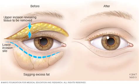 Non-Surgical Eye Lift Near Me | Reduce Hooded Eyelids