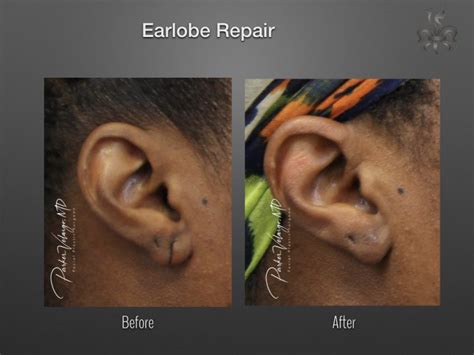 Earlobe Repair Archives - New Orleans Premier Center for Aesthetics and Plastic Surgery