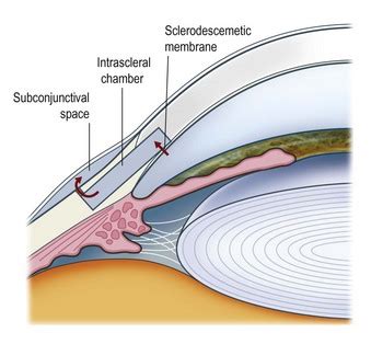 Non-penetrating surgery | Clinical Gate