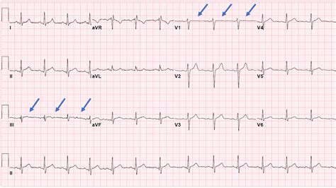 Cureus | Myocardial Ischemia with Cannabinoid Use in an Adolescent