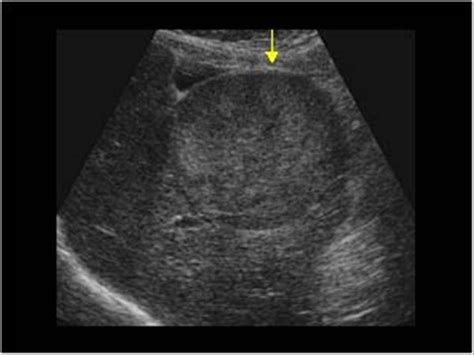 Hepatocellular Carcinoma (HCC) - Stepwards