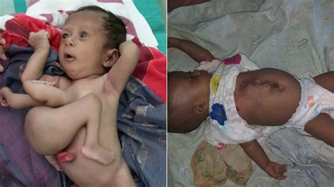 Baby born with parasitic twin has extra limbs removed | Fox News