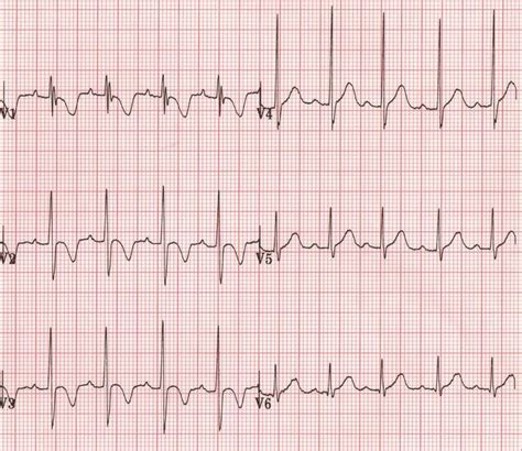 Inverted T waves are seen in the following conditions: Normal finding in children Persiste ...