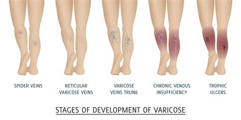 Vein - Stasis Dermatitis : Overview, Causes, Symptoms, Treatment - illness.com