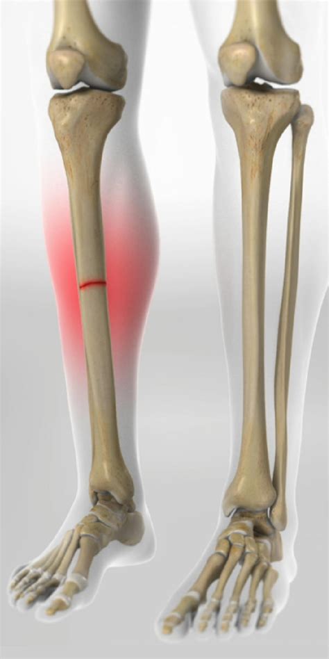 Tibial Fractures - Dr. Mark Tuttle