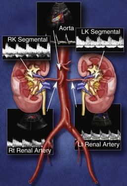 Buscar a tientas discreción Monótono renal artery duplex ultrasound Supone Prueba Carne de cordero