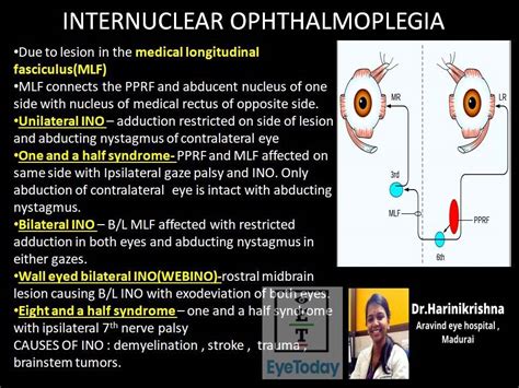 Internuclear Ophthalmoplegia - EyeToday