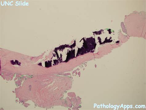 porcelain gallbladder biliary tract histology