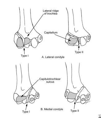 Medial Epicondyle Fracture