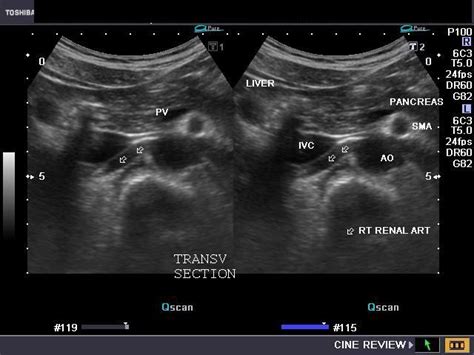 Pics For > Superior Mesenteric Vein Ultrasound | Superior mesenteric artery, Abdominal aorta, Veins