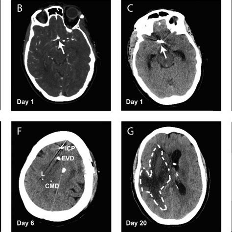 (A) CT-scan at admission showing an interhemispheric Fischer grade 1... | Download Scientific ...