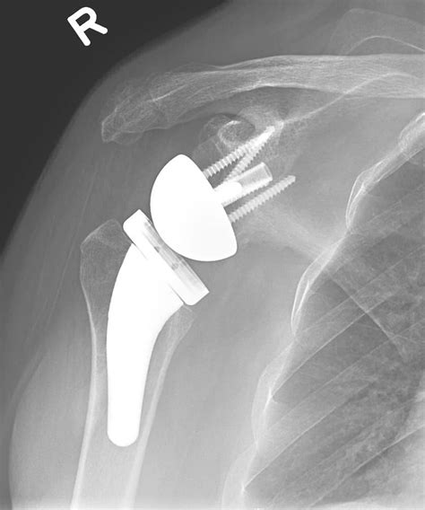 Shoulder Joint Replacement - OrthoInfo - AAOS