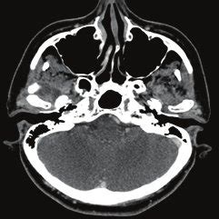 CT scan -axial section. Shows an irregular hypodense lesion in the... | Download Scientific Diagram