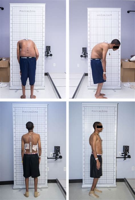 Fig. 1 | Clinical Gait Analysis on a Patient Undergoing Surgical ...