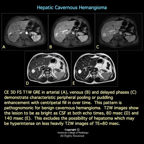 MRI BLOG: Hepatic Cavernous Hemangioma