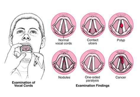 Vocal Cord Nodules & Polyps - Kaushik ENT Hospital