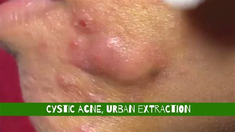 cystic acne, Urban Extraction - YouTube