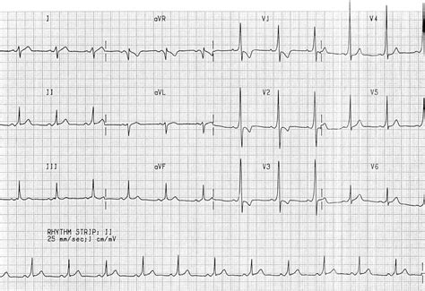 Pre-excitation syndromes • LITFL • ECG Library Diagnosis