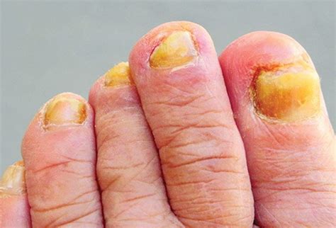 Orange Toenails | Causes & Effective Treatments