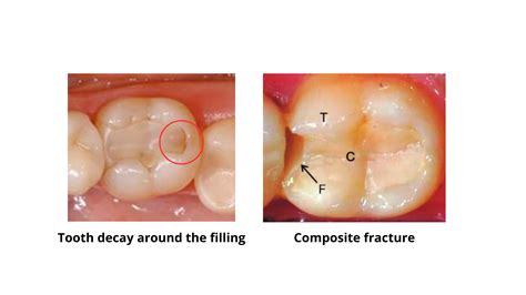 Your Guide to Back Tooth Cavity Filling: Types, Procedure, and Aftercare